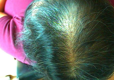 female pattern hair loss