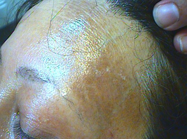 Frontal Fibrosing Alopecia Hair Loss Treatment