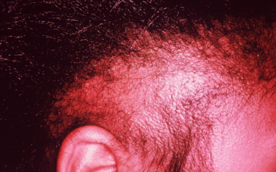 Traction Alopecia