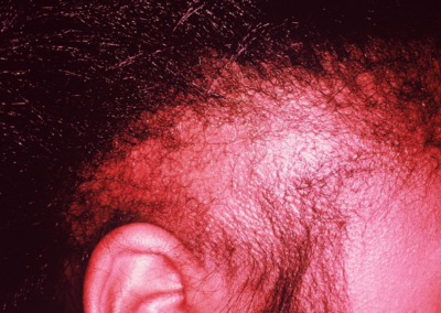 Traction alopecia from long term braiding